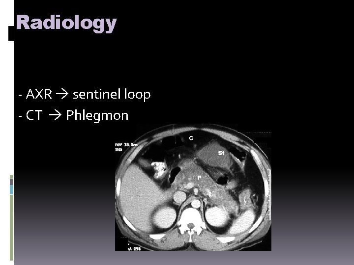 Radiology - AXR sentinel loop - CT Phlegmon 
