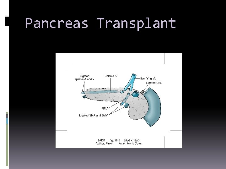 Pancreas Transplant 