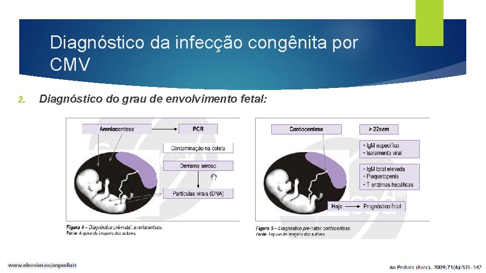 Diagnóstico da infecção congênita por CMV Diagnóstico do grau de envolvimento fetal: 2. 
