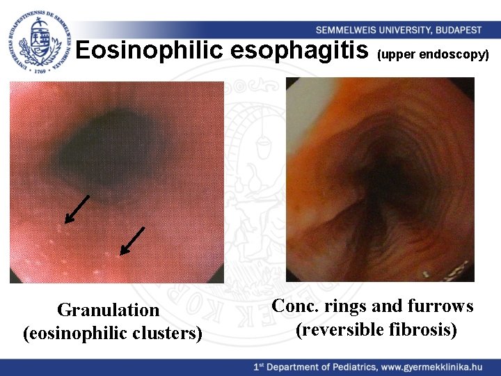 Eosinophilic esophagitis (upper endoscopy) Granulation (eosinophilic clusters) Conc. rings and furrows (reversible fibrosis) 