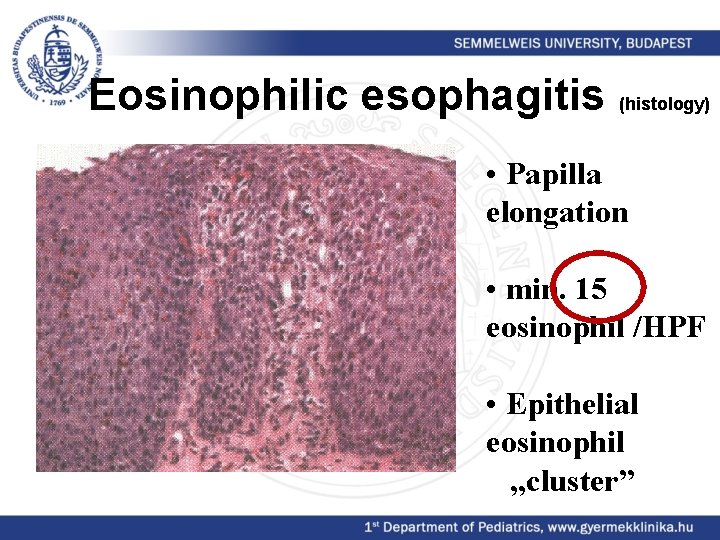 Eosinophilic esophagitis (histology) • Papilla elongation • min. 15 eosinophil /HPF • Epithelial eosinophil