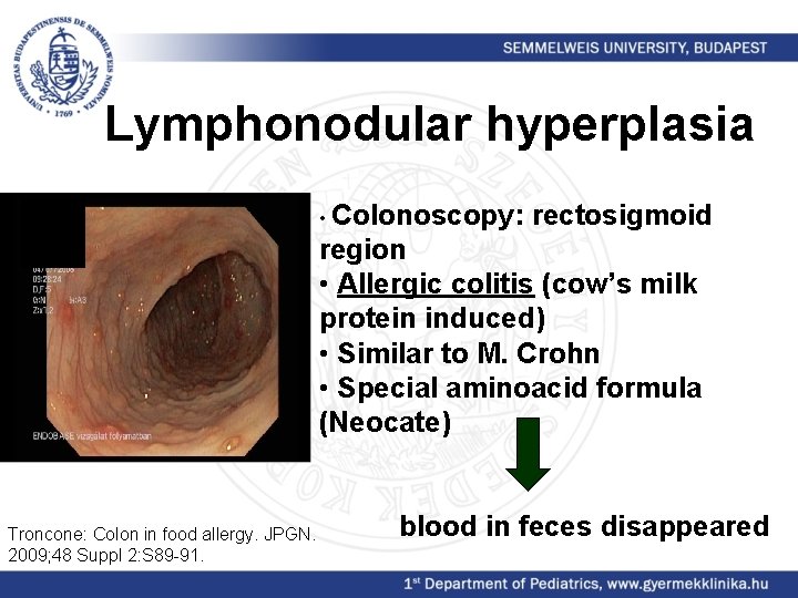 Lymphonodular hyperplasia • Colonoscopy: rectosigmoid region • Allergic colitis (cow’s milk protein induced) •