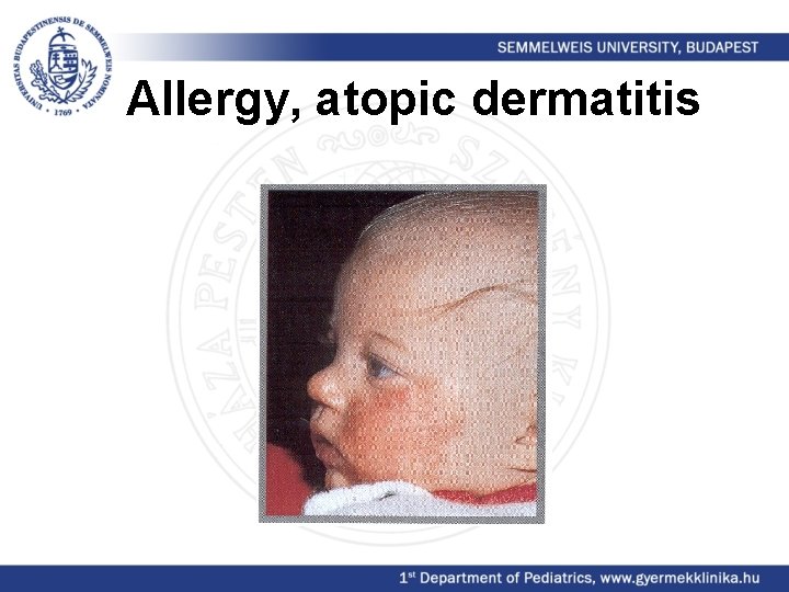 Allergy, atopic dermatitis 