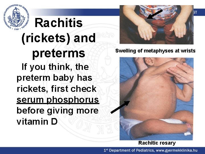 Rachitis (rickets) and preterms Swelling of metaphyses at wrists If you think, the preterm