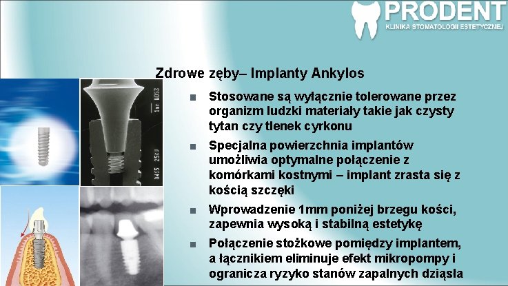 Zdrowe zęby– Implanty Ankylos Stosowane są wyłącznie tolerowane przez organizm ludzki materiały takie jak