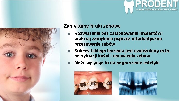 Zamykamy braki zębowe Rozwiązanie bez zastosowania implantów: braki są zamykane poprzez ortodontyczne przesuwanie zębów