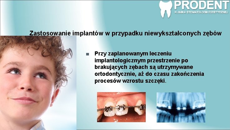 Zastosowanie implantów w przypadku niewykształconych zębów Przy zaplanowanym leczeniu implantologicznym przestrzenie po brakujących zębach