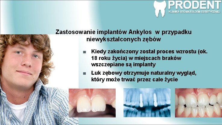 Zastosowanie implantów Ankylos w przypadku niewykształconych zębów Kiedy zakończony został proces wzrostu (ok. 18