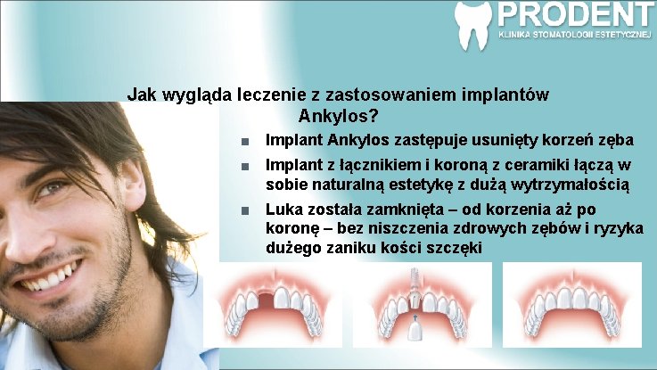 Jak wygląda leczenie z zastosowaniem implantów Ankylos? Implant Ankylos zastępuje usunięty korzeń zęba Implant