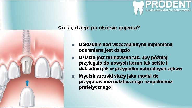 Co się dzieje po okresie gojenia? Dokładnie nad wszczepionymi implantami odsłaniane jest dziąsło Dziąsło