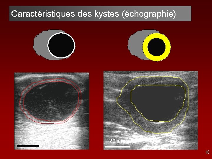 Caractéristiques des kystes (échographie) 20 mm 16 