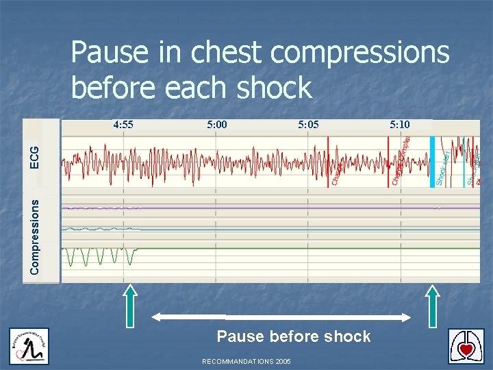 Pause in chest compressions before each shock 5: 00 5: 05 Compressions ECG 4: