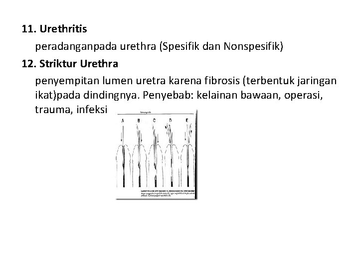 11. Urethritis peradanganpada urethra (Spesifik dan Nonspesifik) 12. Striktur Urethra penyempitan lumen uretra karena