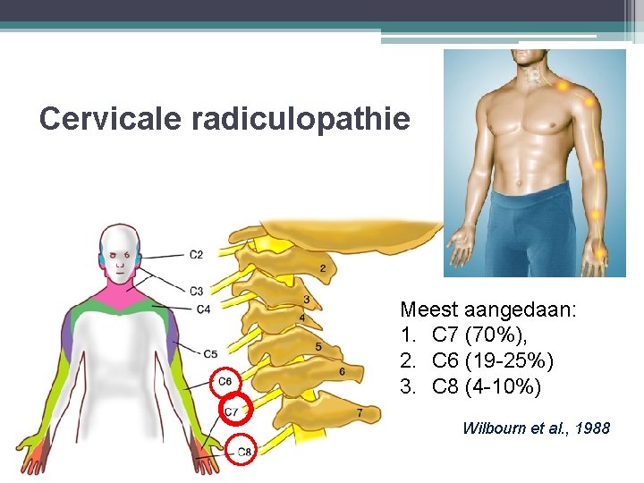 Cervicale radiculopathie Meest aangedaan: 1. C 7 (70%), 2. C 6 (19 -25%) 3.