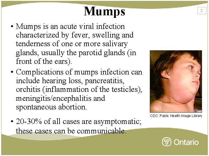 Mumps 2 • Mumps is an acute viral infection characterized by fever, swelling and