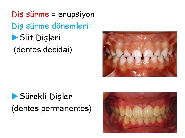 Diş sürme = erupsiyon Diş sürme dönemleri: ►Süt Dişleri (dentes decidai) ►Sürekli Dişler (dentes Diş sürme = erupsiyon Diş sürme dönemleri: ►Süt Dişleri (dentes decidai) ►Sürekli Dişler (dentes