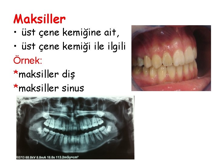 Maksiller • üst çene kemiğine ait, • üst çene kemiği ile ilgili Örnek: *maksiller Maksiller • üst çene kemiğine ait, • üst çene kemiği ile ilgili Örnek: *maksiller