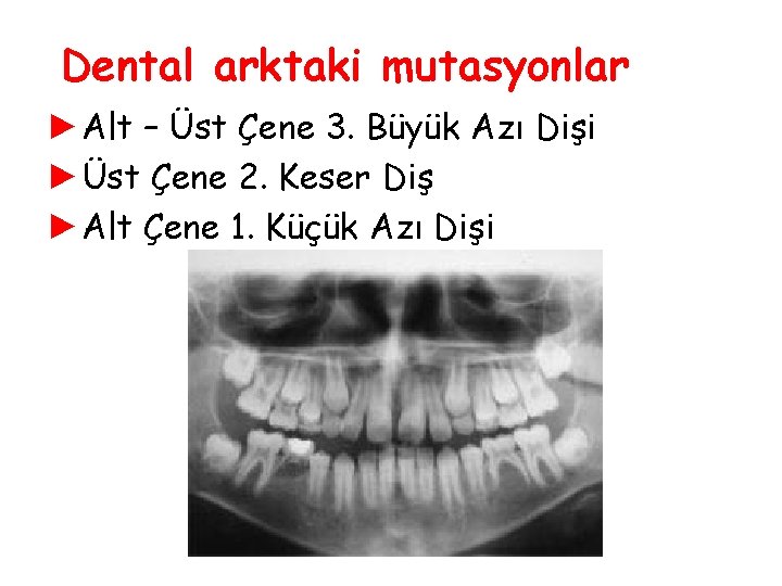 Dental arktaki mutasyonlar ►Alt – Üst Çene 3. Büyük Azı Dişi ►Üst Çene 2. Dental arktaki mutasyonlar ►Alt – Üst Çene 3. Büyük Azı Dişi ►Üst Çene 2.