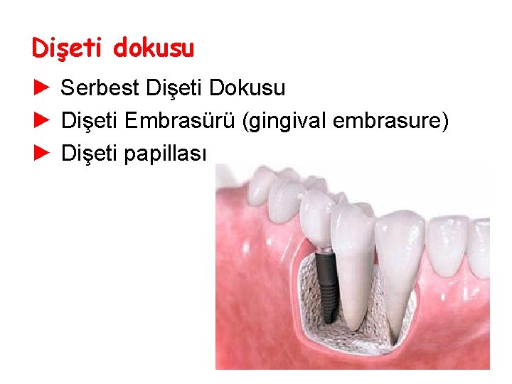Dişeti dokusu ► Serbest Dişeti Dokusu ► Dişeti Embrasürü (gingival embrasure) ► Dişeti papillası Dişeti dokusu ► Serbest Dişeti Dokusu ► Dişeti Embrasürü (gingival embrasure) ► Dişeti papillası