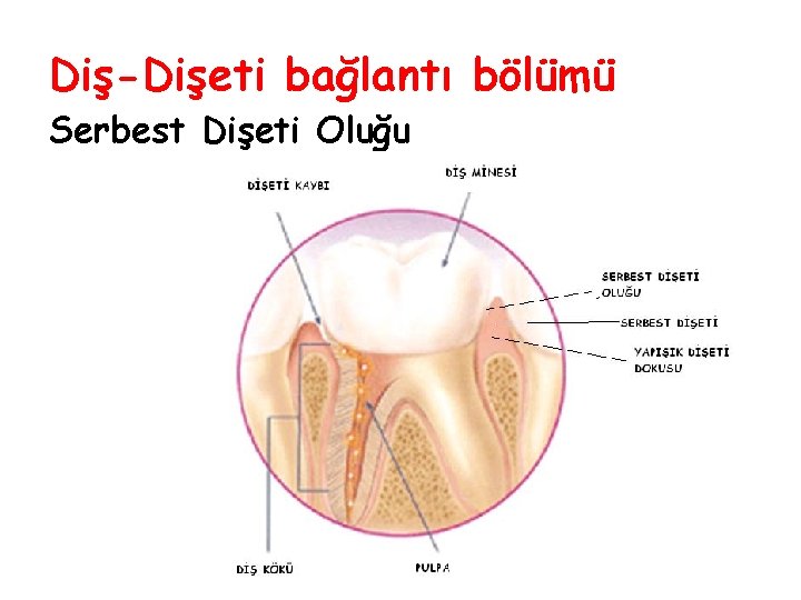 Diş-Dişeti bağlantı bölümü Serbest Dişeti Oluğu Diş-Dişeti bağlantı bölümü Serbest Dişeti Oluğu
