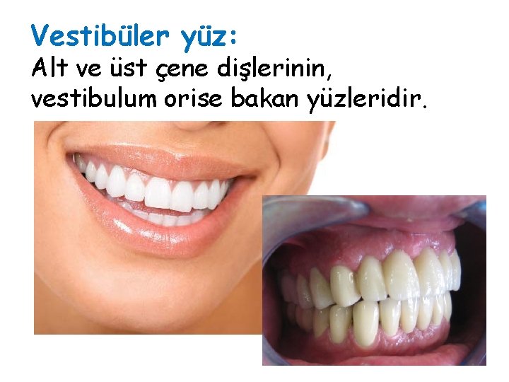 Vestibüler yüz: Alt ve üst çene dişlerinin, vestibulum orise bakan yüzleridir. Vestibüler yüz: Alt ve üst çene dişlerinin, vestibulum orise bakan yüzleridir.