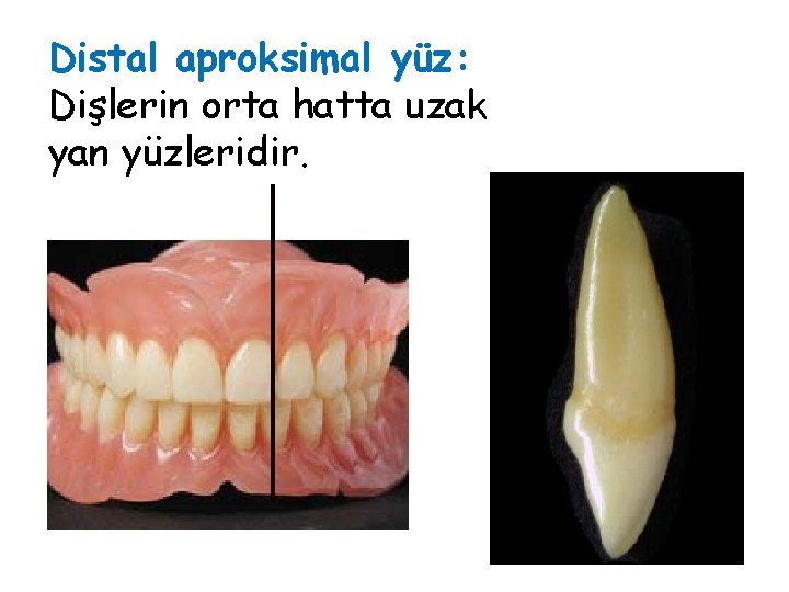 Distal aproksimal yüz: Dişlerin orta hatta uzak yan yüzleridir. Distal aproksimal yüz: Dişlerin orta hatta uzak yan yüzleridir.