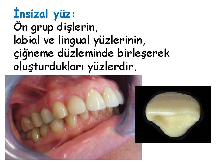 İnsizal yüz: Ön grup dişlerin, labial ve lingual yüzlerinin, çiğneme düzleminde birleşerek oluşturdukları yüzlerdir. İnsizal yüz: Ön grup dişlerin, labial ve lingual yüzlerinin, çiğneme düzleminde birleşerek oluşturdukları yüzlerdir.
