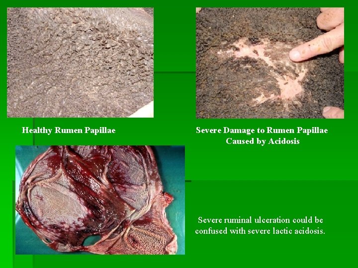 Healthy Rumen Papillae Severe Damage to Rumen Papillae Caused by Acidosis Severe ruminal ulceration