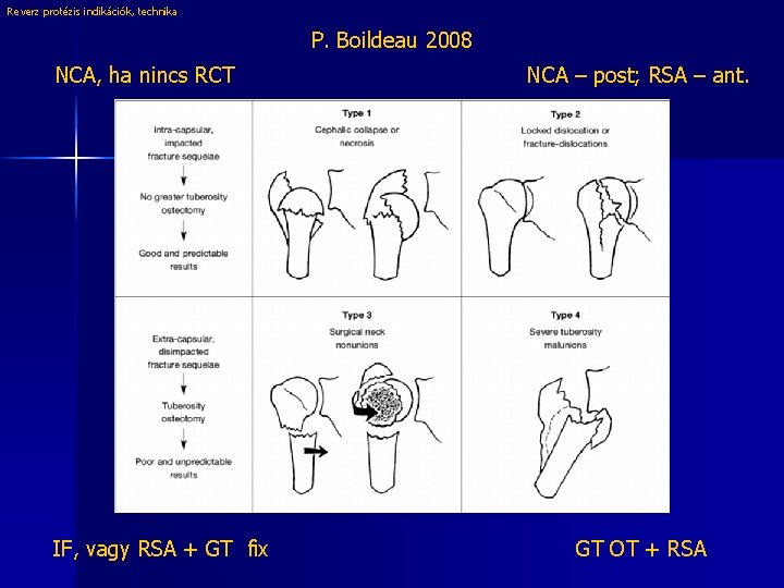 Reverz protézis indikációk, technika P. Boildeau 2008 NCA, ha nincs RCT IF, vagy RSA
