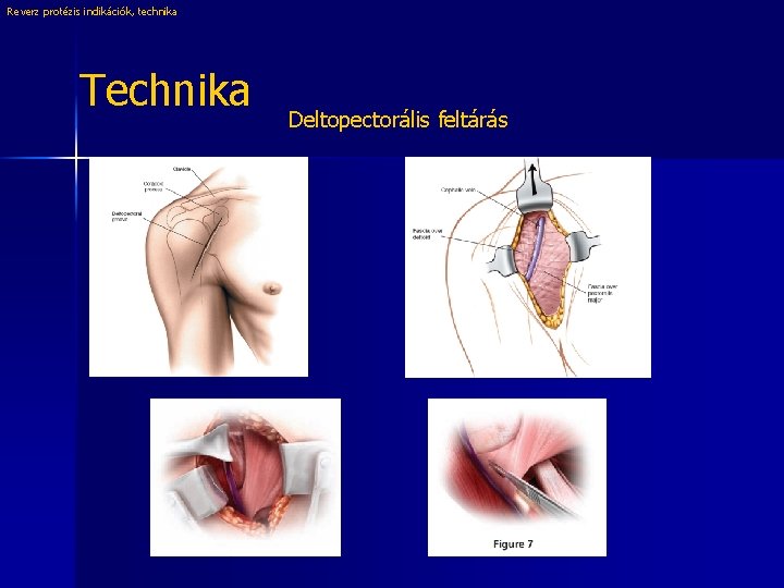 Reverz protézis indikációk, technika Technika Deltopectorális feltárás 