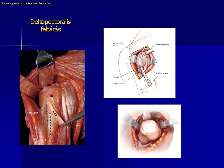 Reverz protézis indikációk, technika Deltopectorális feltárás 