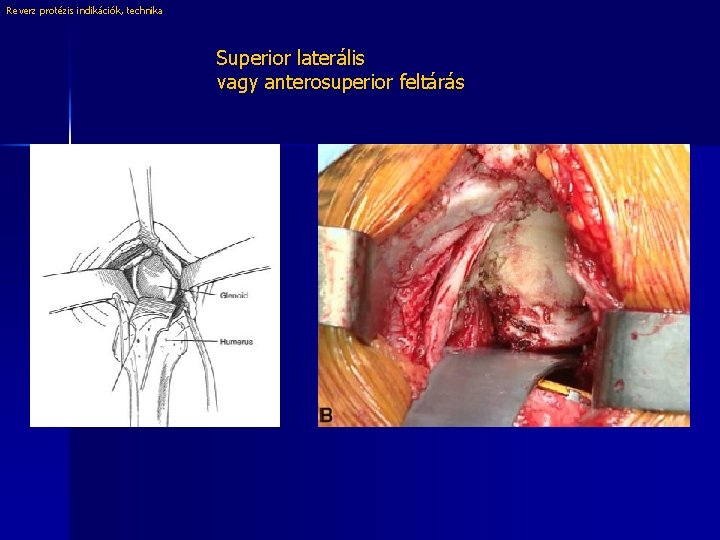 Reverz protézis indikációk, technika Superior laterális vagy anterosuperior feltárás 