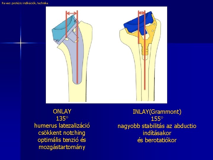 Reverz protézis indikációk, technika ONLAY 135° humerus latezalizáció csökkent notching optimális tenzió és mozgástartomány