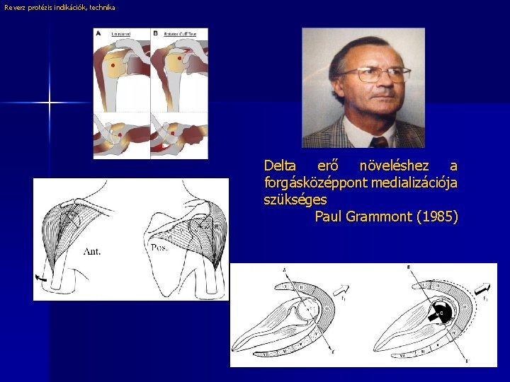 Reverz protézis indikációk, technika Delta erő növeléshez a forgásközéppont medializációja szükséges Paul Grammont (1985)