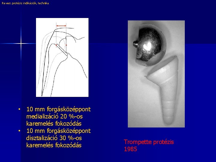 Reverz protézis indikációk, technika • 10 mm forgásközéppont medializáció 20 %-os karemelés fokozódás •