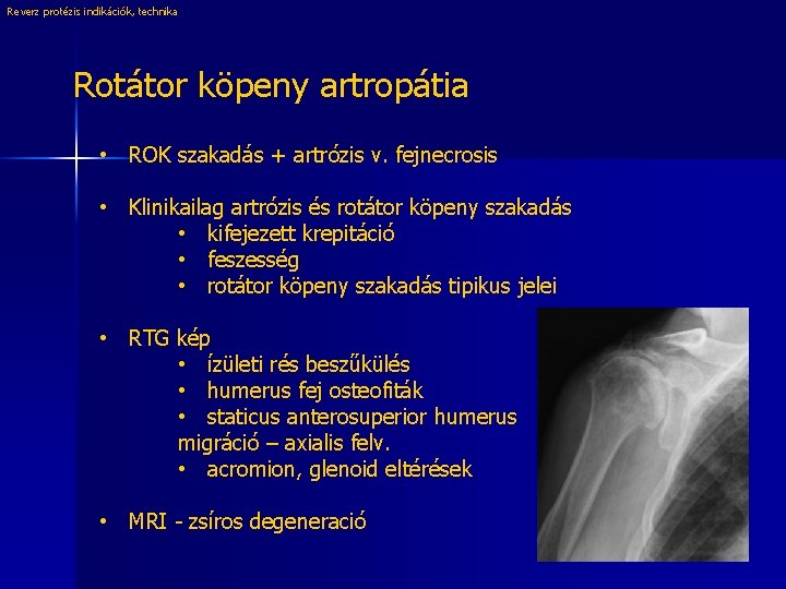 Reverz protézis indikációk, technika Rotátor köpeny artropátia • ROK szakadás + artrózis v. fejnecrosis