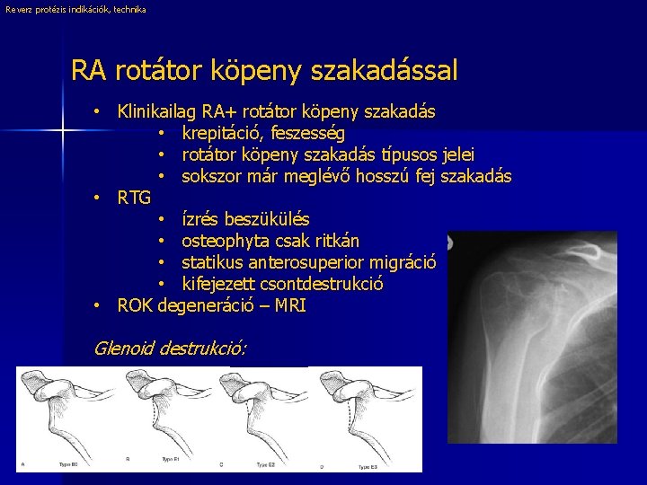 Reverz protézis indikációk, technika RA rotátor köpeny szakadással • Klinikailag RA+ rotátor köpeny szakadás