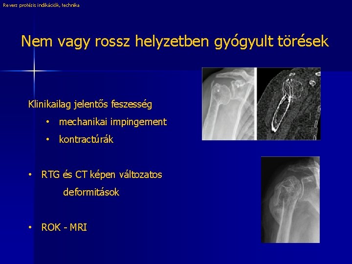 Reverz protézis indikációk, technika Nem vagy rossz helyzetben gyógyult törések Klinikailag jelentős feszesség •