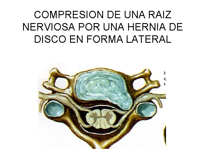 COMPRESION DE UNA RAIZ NERVIOSA POR UNA HERNIA DE DISCO EN FORMA LATERAL 