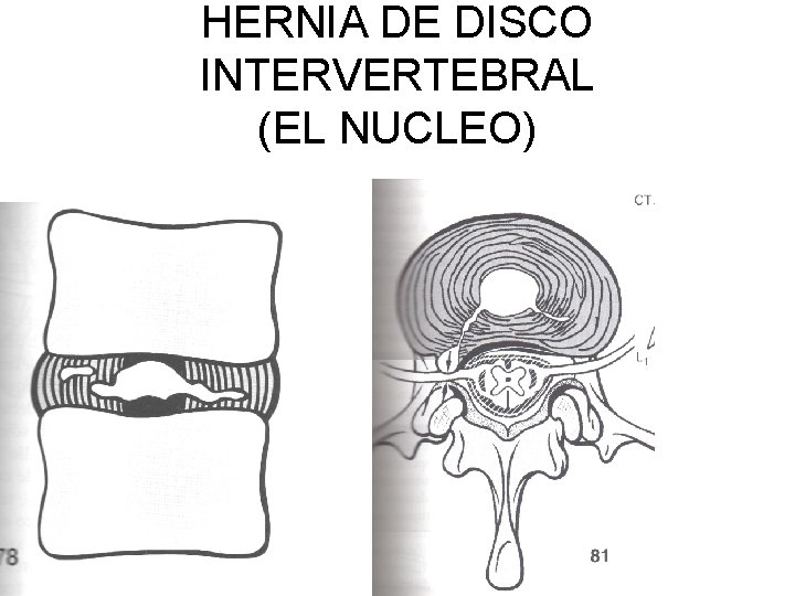 HERNIA DE DISCO INTERVERTEBRAL (EL NUCLEO) 