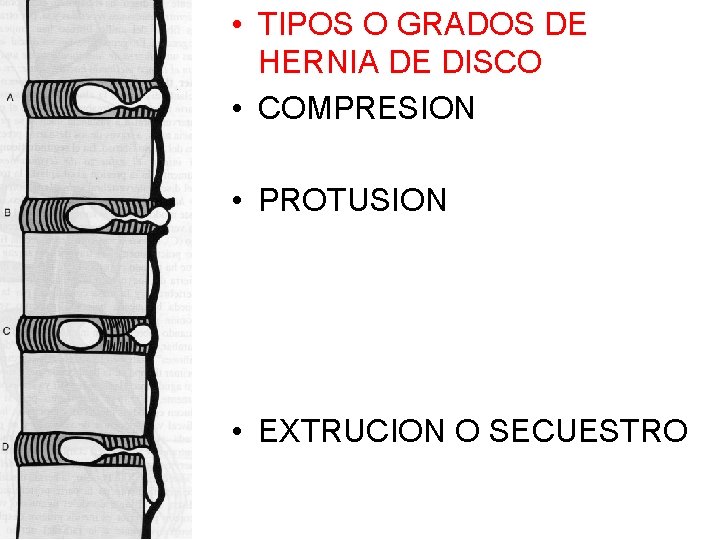  • TIPOS O GRADOS DE HERNIA DE DISCO • COMPRESION • PROTUSION •