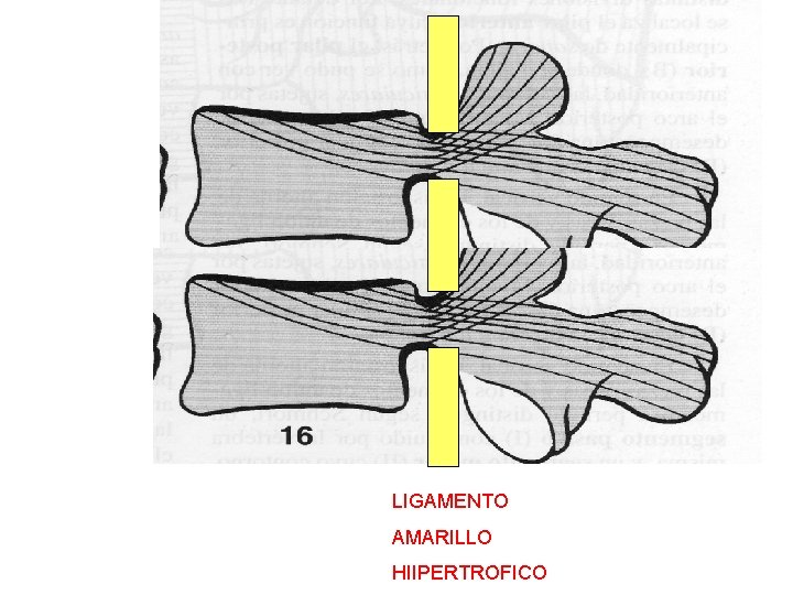 LIGAMENTO AMARILLO HIIPERTROFICO 