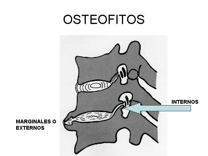 OSTEOFITOS INTERNOS MARGINALES O EXTERNOS 