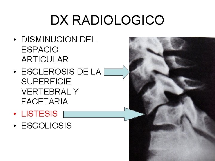 DX RADIOLOGICO • DISMINUCION DEL ESPACIO ARTICULAR • ESCLEROSIS DE LA SUPERFICIE VERTEBRAL Y