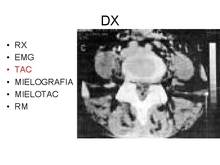 DX • • • RX EMG TAC MIELOGRAFIA MIELOTAC RM 