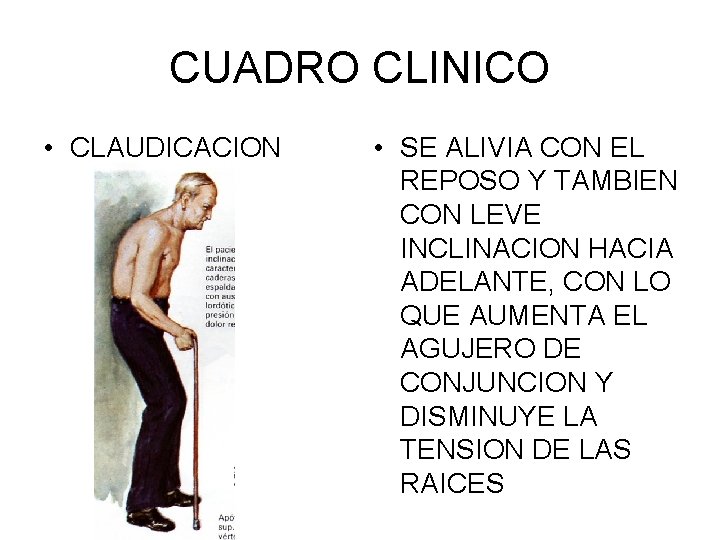 CUADRO CLINICO • CLAUDICACION • SE ALIVIA CON EL REPOSO Y TAMBIEN CON LEVE