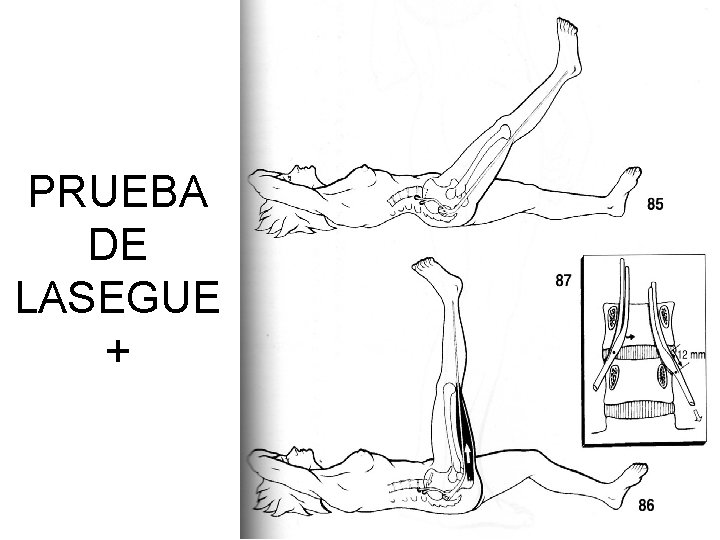 PRUEBA DE LASEGUE + 
