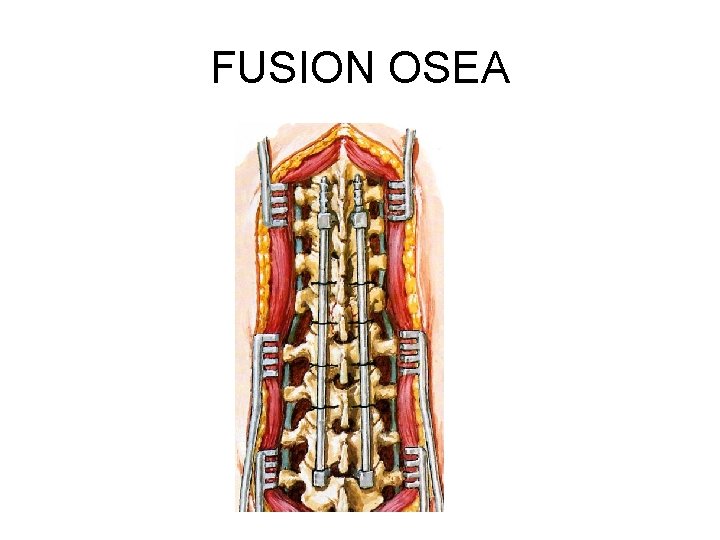 FUSION OSEA 