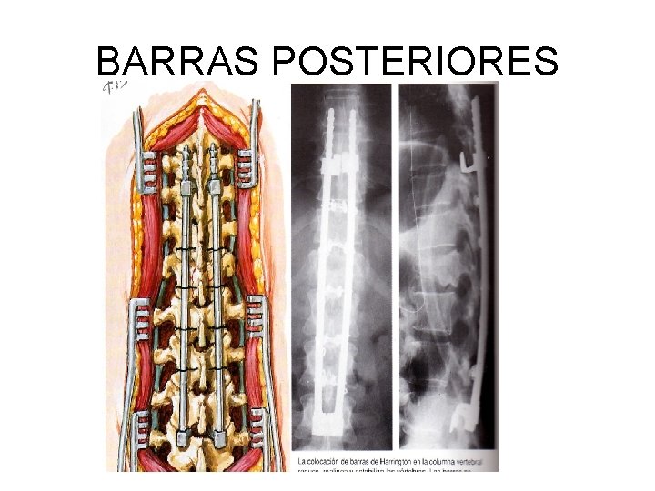BARRAS POSTERIORES 