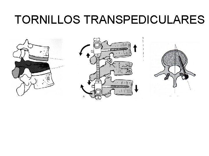 TORNILLOS TRANSPEDICULARES 